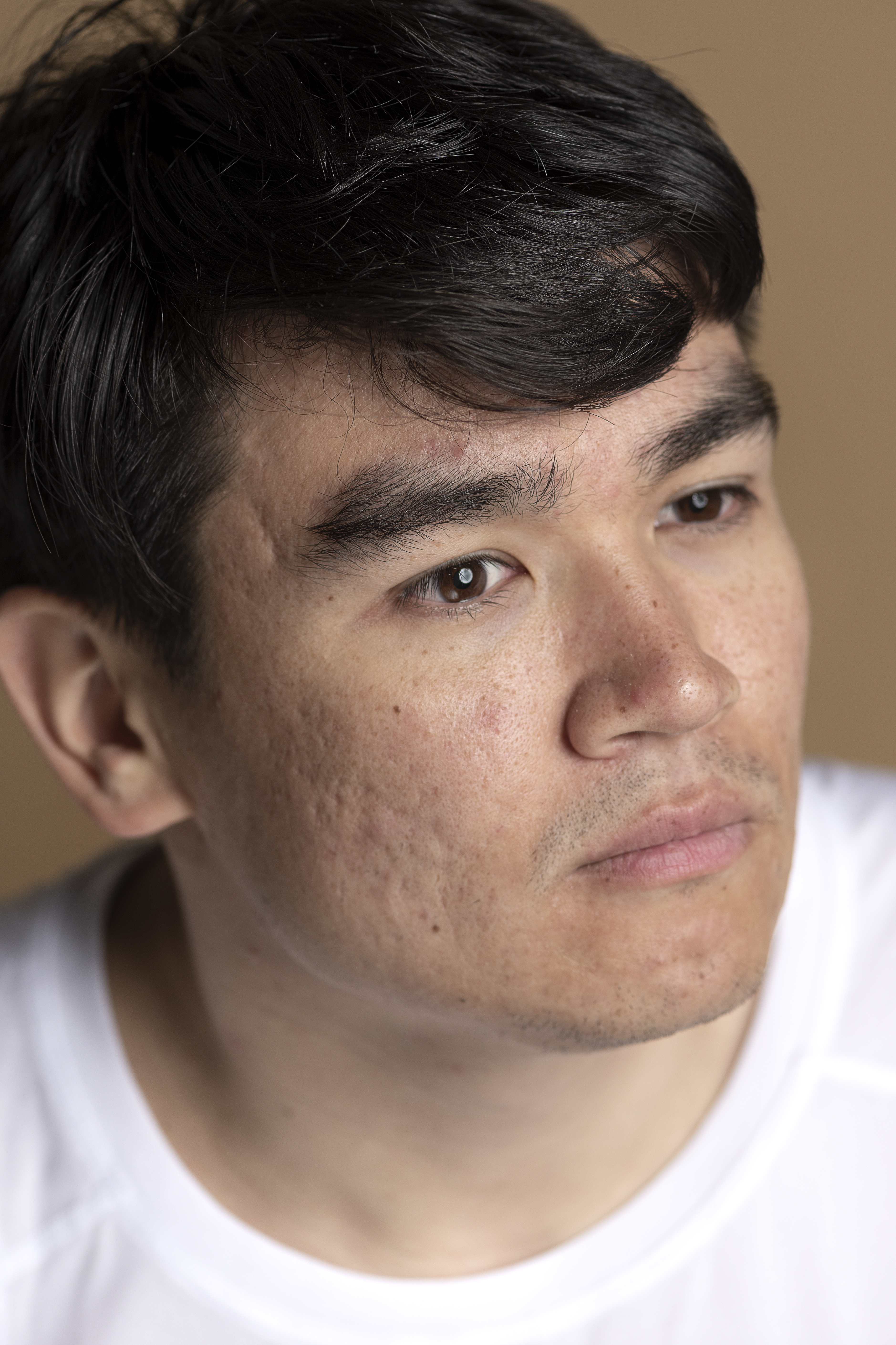 Acne Scars treatment